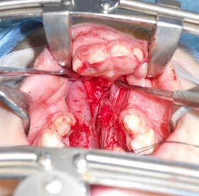 The three other cases underwent the surgical technique described before. Case 2 had cleft palate repair 13 months later.