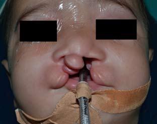 A B C Fig. 2. (case 2): A 6 months male with CBCL with protruding premaxilla and palate cleft. (A) Preoperative anterior view.