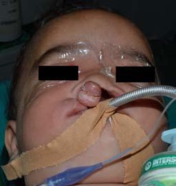 A B C Fig. 4. (case 4): A 7 months female with CBCL with protruding premaxilla and palate cleft. (A) Preoperative anterior view.