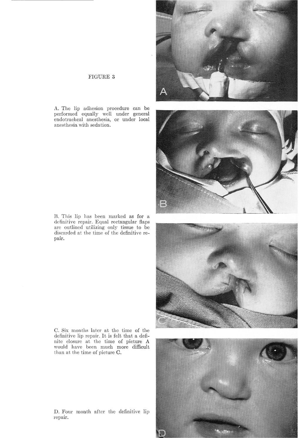 FIGURE 3 A. The lip adhesion procedure can be performed equally well under general endotracheal anesthesia, or under local anesthesia with sedation. B.