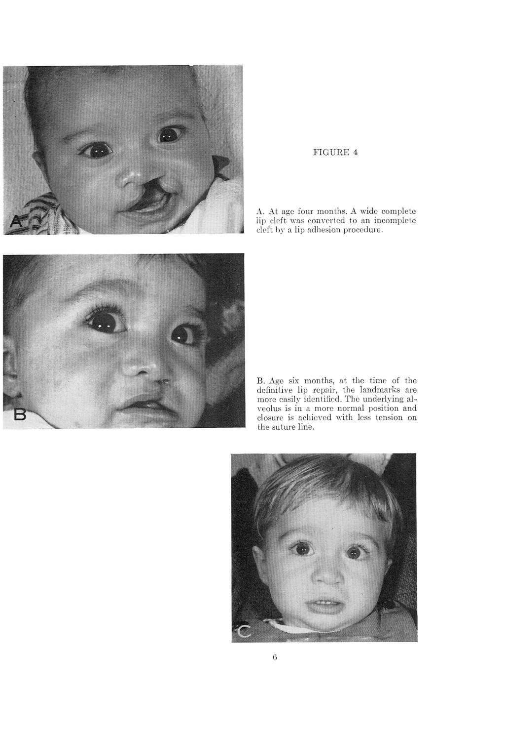FIGURE 4 A. At age four months. A wide complete lip cleft was converted to an incomplete cleft by a lip adhesion procedure. B.