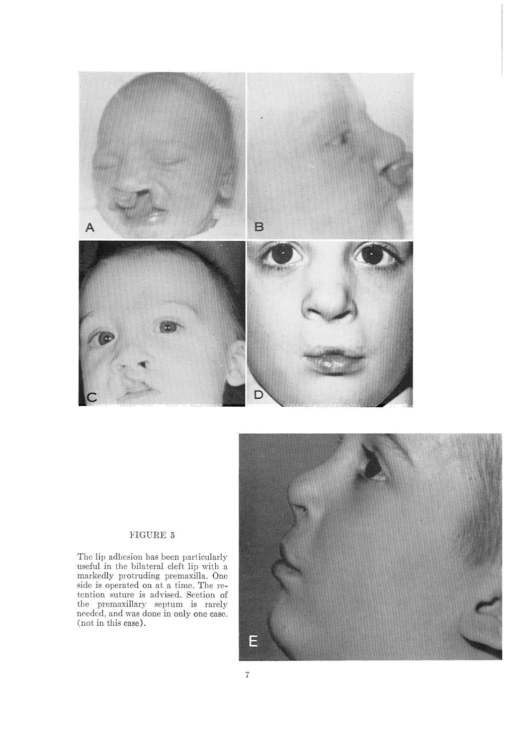 FIGURE 5 The lip adhesion has been particularly useful in the bilateral cleft lip with a markedly protruding premaxilla.