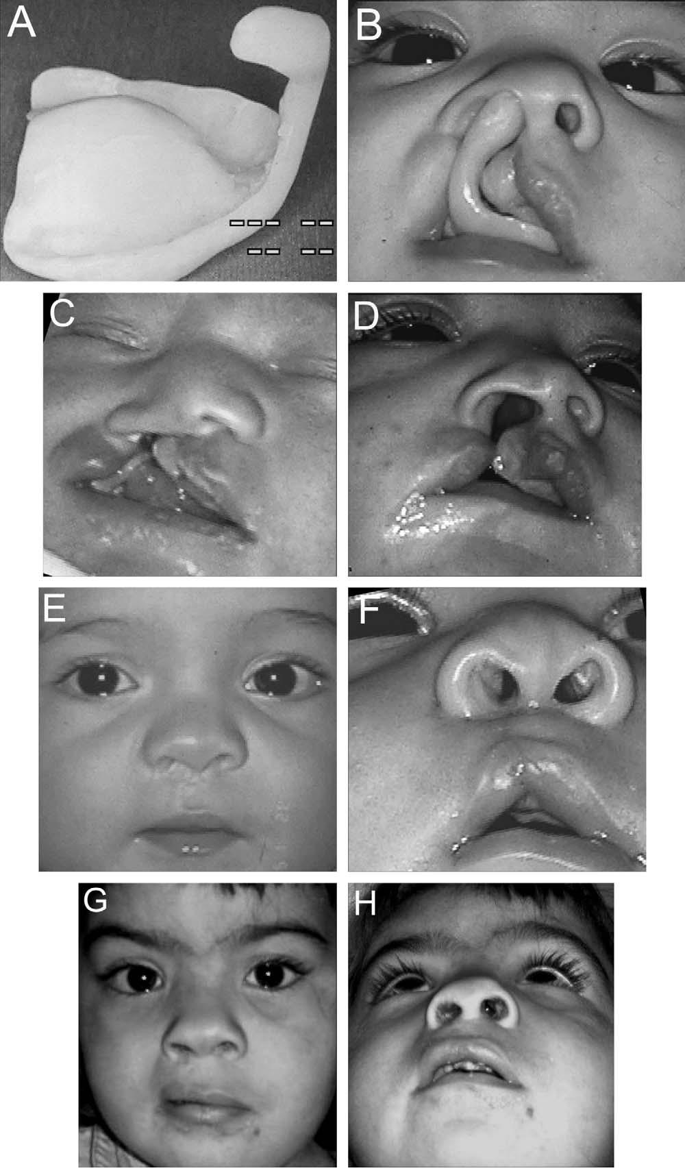 640 Cleft Palate Craniofacial Journal, November 2006, Vol. 43 No. 6 FIGURE 1 Patient with complete unilateral cleft lip and palate.