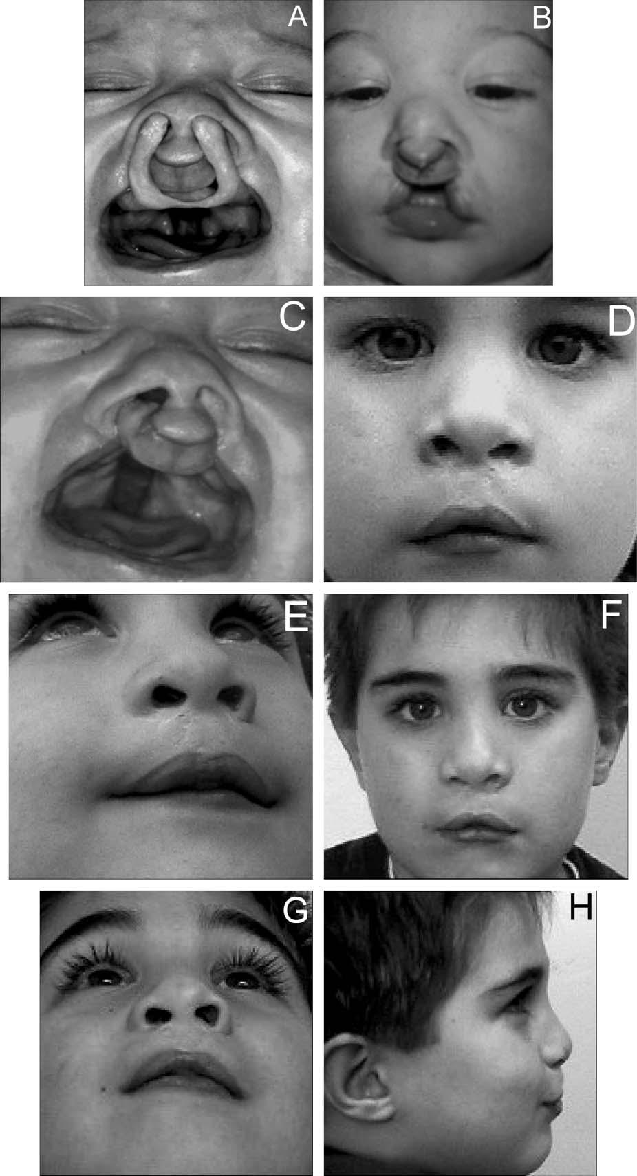 Bennun and Figueroa, DYNAMIC PRESURGICAL NASAL REMODELING 641 FIGURE 2 Patient with complete bilateral cleft lip and palate. A: Undergoing bilateral nasal remodeling with the original appliance.