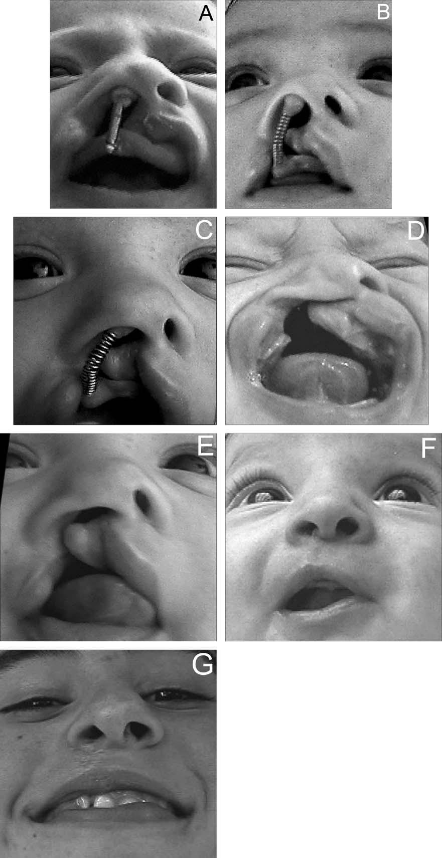 Bennun and Figueroa, DYNAMIC PRESURGICAL NASAL REMODELING 643 FIGURE 4 Patient with unilateral cleft lip and palate undergoing DPNR with the new appliance.