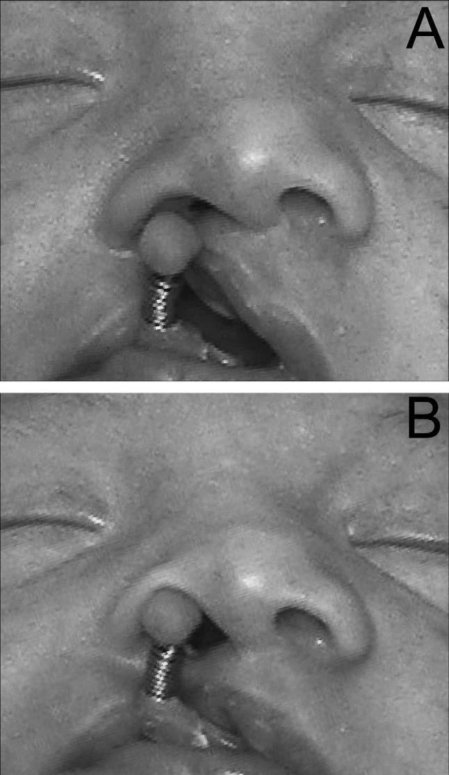 Note the excellent nasal projection, columellar length, and nasal and nostril symmetry. plate midline, in line with the lip and alveolar cleft. In bilateral cases, two stents are used.