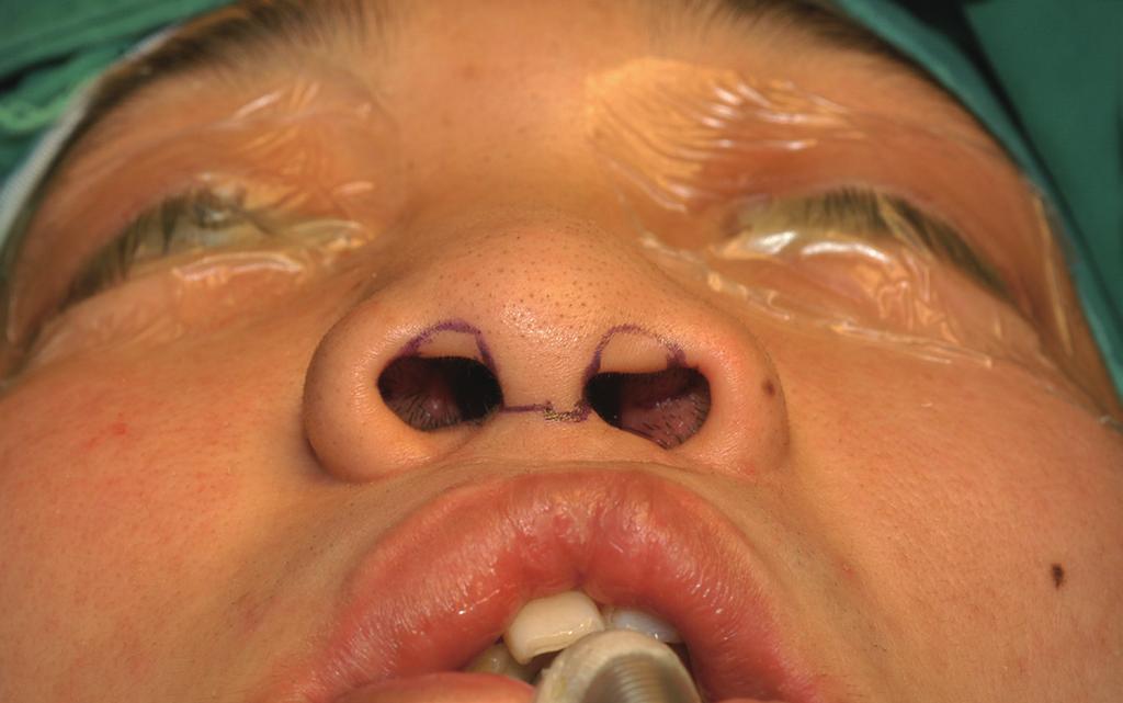 () Open rhinoplasty with a bilateral reverse-u incision and V-Y plasty.