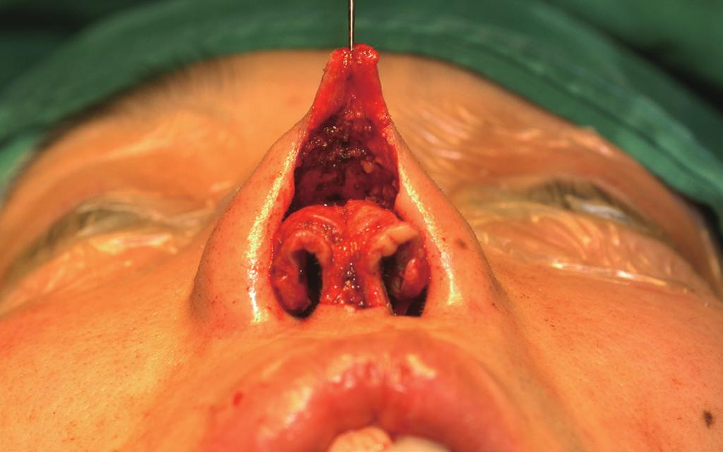 () fter exposure of both lower lateral cartilages, the alar-columellar web is present on the left nostril.