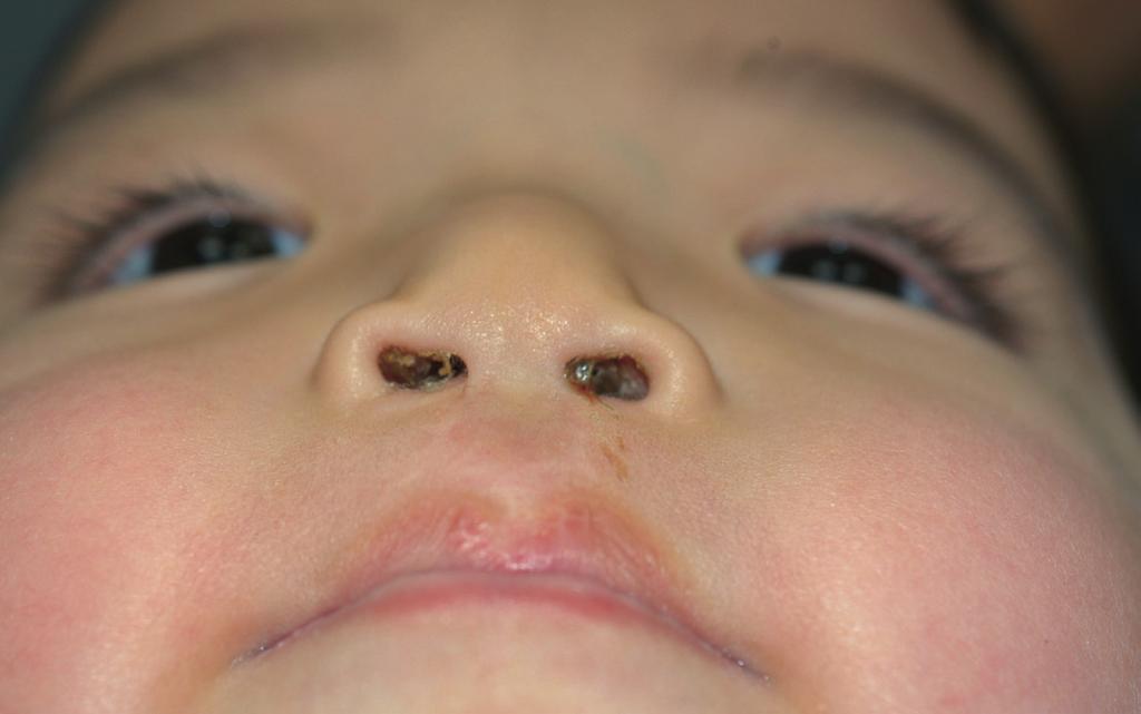 3-year-old boy with a bilateral cleft lip nasal deformity with a short columella 3-year-old boy with a