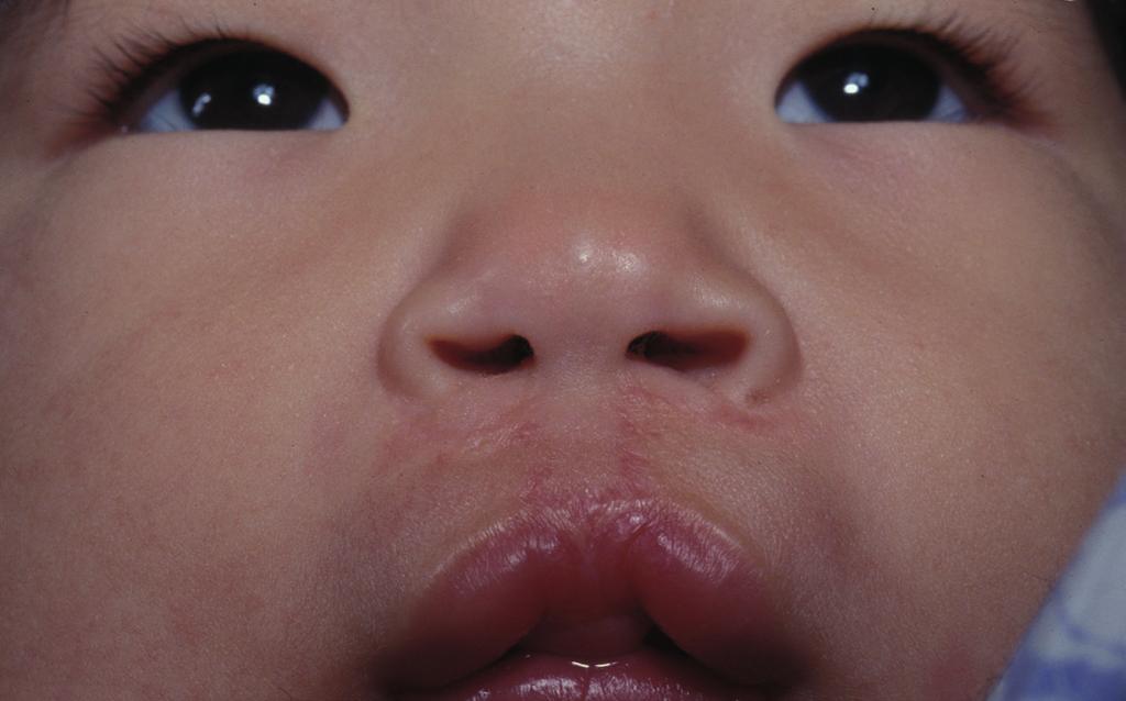 3-year-old girl with a bilateral cleft lip nasal deformity with a short columella 3-year-old girl with a 