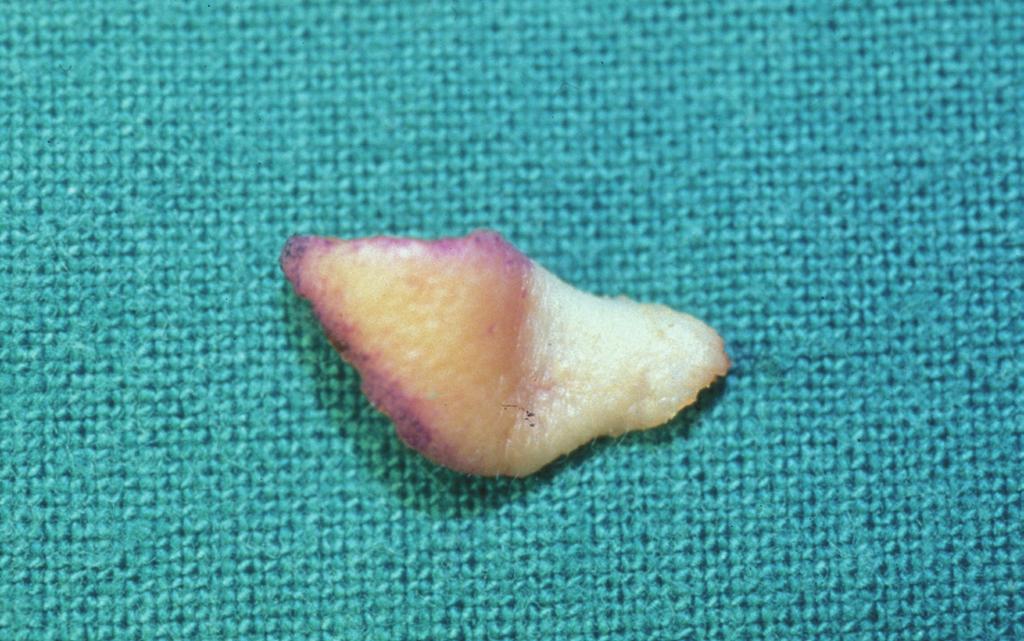 a bilateral reverse-u incision and V-Y plasty combined with a composite graft. () Preoperative view. () Composite graft from helix. (C) Ten-year postoperative view.