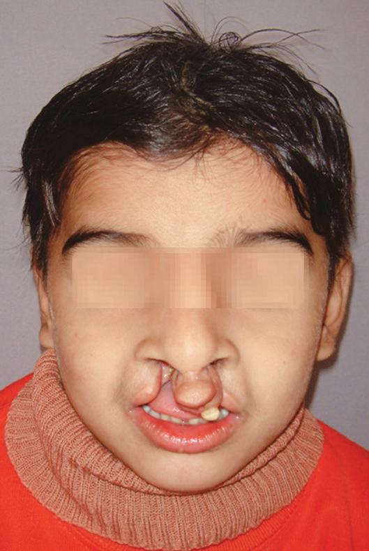 Pradeep Raghav et al CASE REPORT The patient Juber aged 4 years and 2 months reported with complete bilateral cleft lip and palate with markedly protruded premaxillary segment shifted to the left