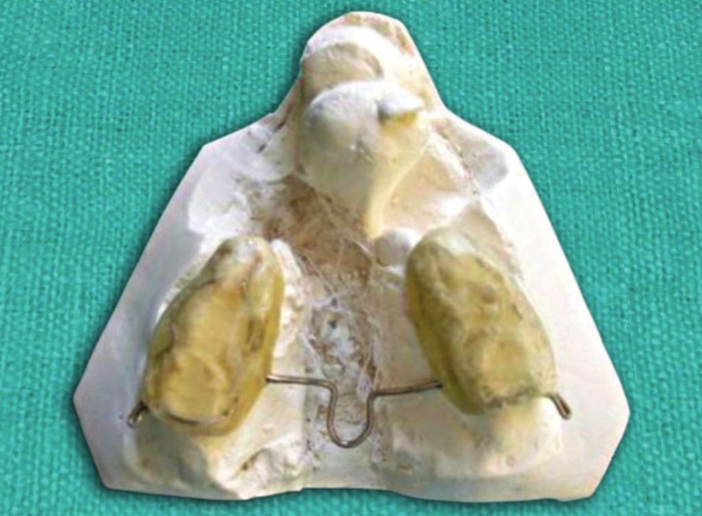 IJCPD Fig. 4A: Occlusal splint Fig. 5: Intraoral view of modified repositioning appliance Fig.