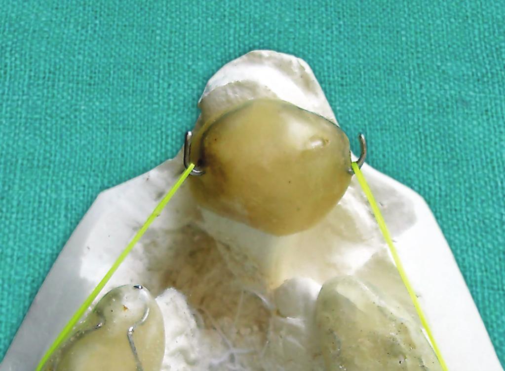 The maxillary occlusion splint was cemented on both maxillary segments with GIC cement.