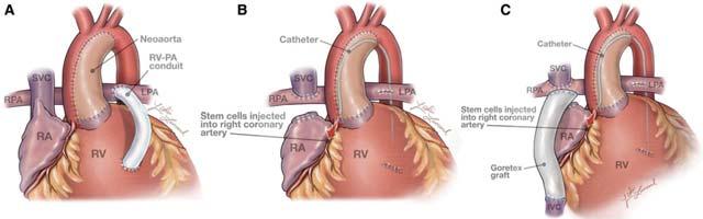 surgical palliation for patients with hypoplastic left heart