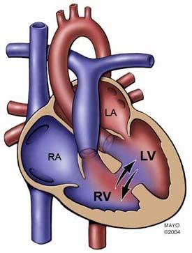 Eisenmenger Syndrome Large L R shunt produces pulmonary