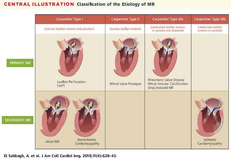 Steps in Defining The Mechanism of MR: Define Leaflet Motion and Morphology 21 Carpentier Classification Type 1 (Normal Motion) Endocarditis, perforation, clefts (primary MR) Normal anatomy (atrial
