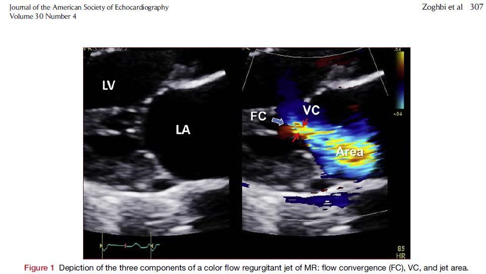 ASSESSMENT OF MR SEVERITY Color Flow Doppler Primary tool to screen for MR Absence of a color Doppler jet excludes MR Caveat: