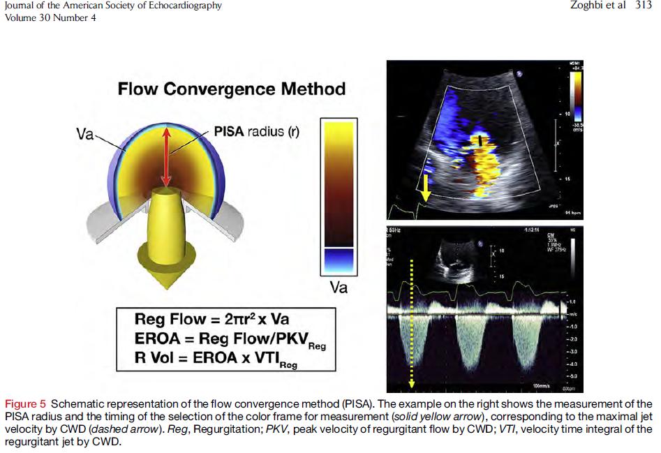 Flow Convergence (PISA) Derived ERO Baseline shift in direction of flow Down on TTE Up on TEE Calculate the ERO as well as the Rvol Many