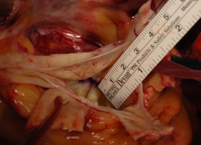reimplantation & distal suture line 6.