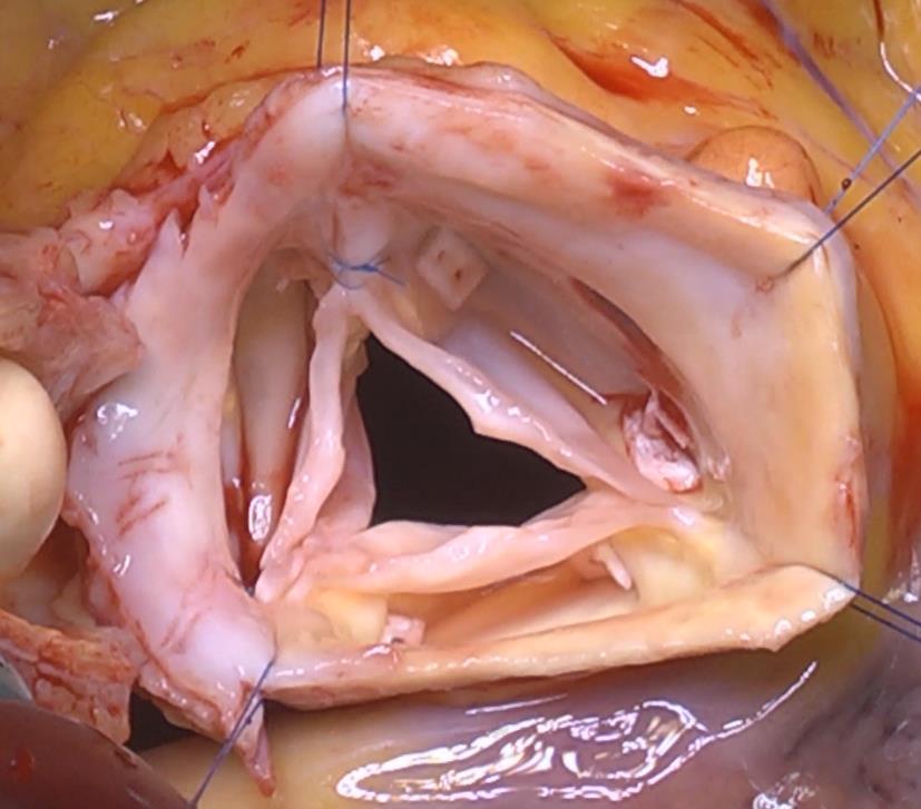 Techniques of FAA repair Aorta lesions