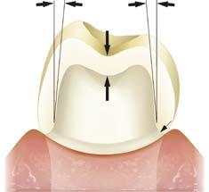 The prepared tooth should follow these guidelines: Taper angle of greater than 6 All intended line angles should have a radius (0.