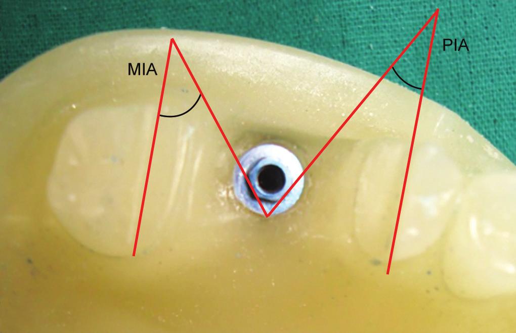 Manesh Lahori et al tray using polyvinylsiloxane and polyether impression material. Objectives To obtain accurate master cast for single tooth implant restoration.