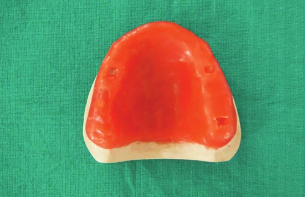 To compare the accuracy of open and close tray technique for single tooth implant replacement.