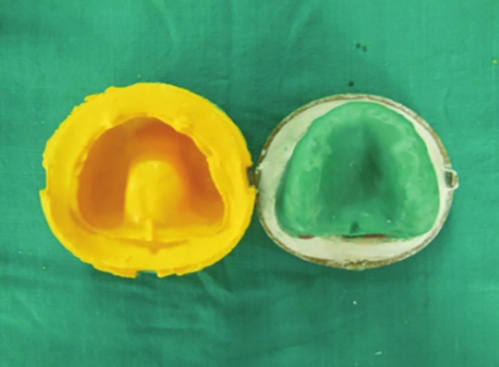An in vitro Study to Compare the Accuracy of Master Cast Fabricated by Three Different Transfer Techniques for Single Tooth Fig.