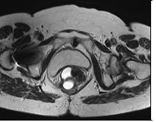 2. Methods a. MRI acquisition MRI was performed with MAGNETOM ESSENZA scanner (SIEMENS, Germany), with field strength of 1.5 Т, using a body matrix coil in T2-weighted sequence.