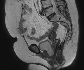 MRI was conducted prior to and after retrograde filling of the rectum. In all cases, the doze administered through the rectum was well tolerated by patients. 2.