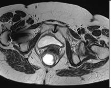 The plastic reconstruction of the rectovaginal fistula was performed. At the expiration of 2 months after the surgery, MRI without contrast enhancement of the rectum did not identify a fistula (Fig.