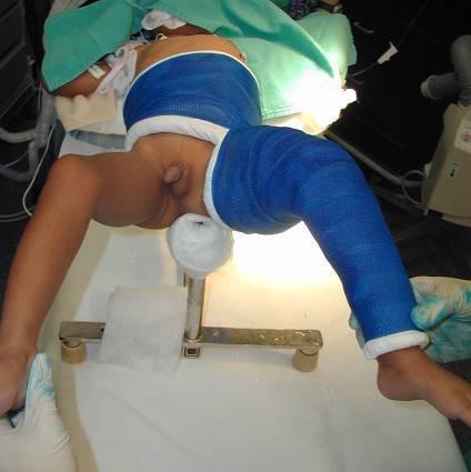 (A) Treatment with a Pavlik Harness or a spica cast are options for infants 6 months and younger with a diaphyseal
