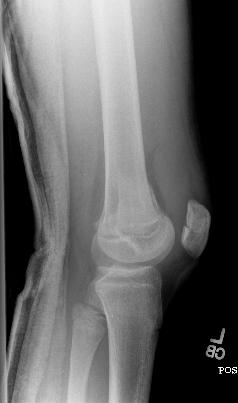 fractures may be treated with closed reduction and