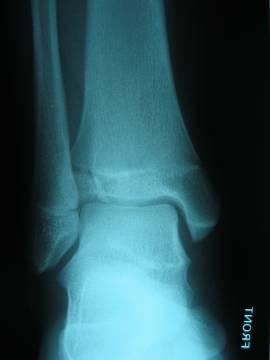 Ankle Fractures Ankle Fractures Transitional Ankle