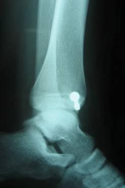fixation 13 yo girl with ankle injury Tilleaux Fracture
