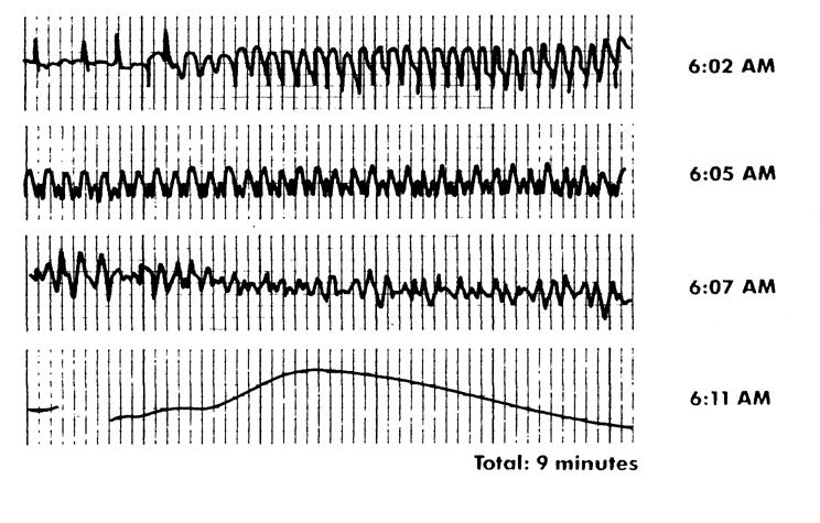 AV Synchrony Cardiac Output = Stroke Volume Heart Rate Facilitates venous return Increases LVEDP Maintains appropriate opening and closing of AV valves Hemodynamic advantage of AV sequential pacing