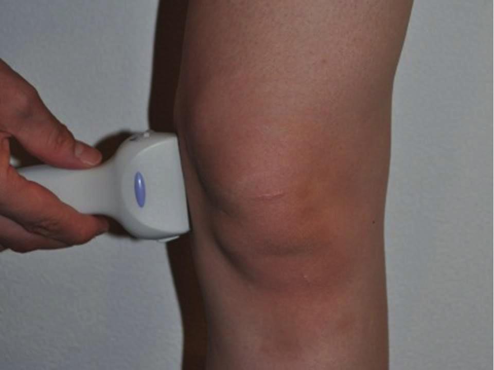injections of hyaluronic acid into unilateral knees at the time of diagnosis of knee osteoarthritis were studied.