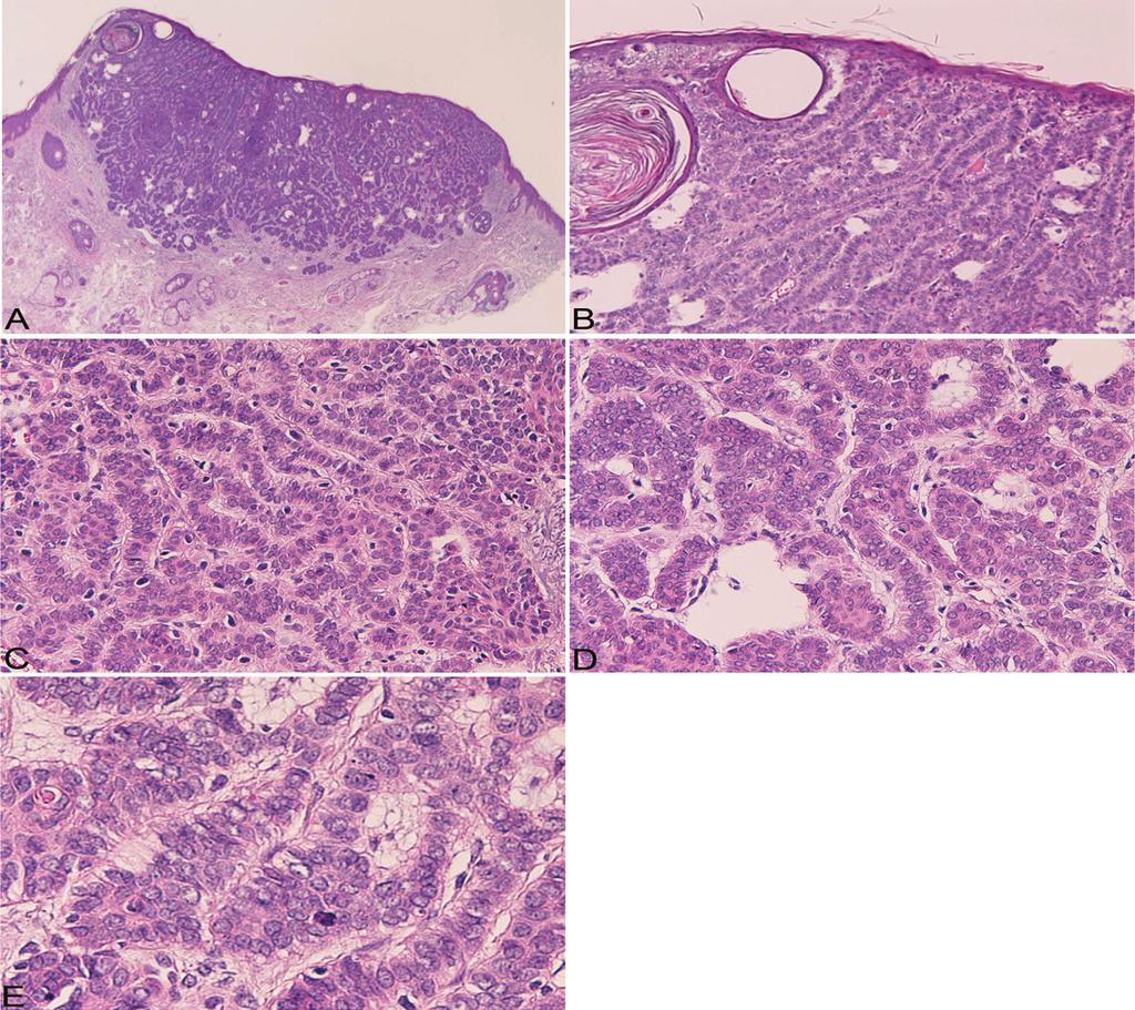 Figure 1. Morphologically of the tumor. The tumor is located in the dermis (A).