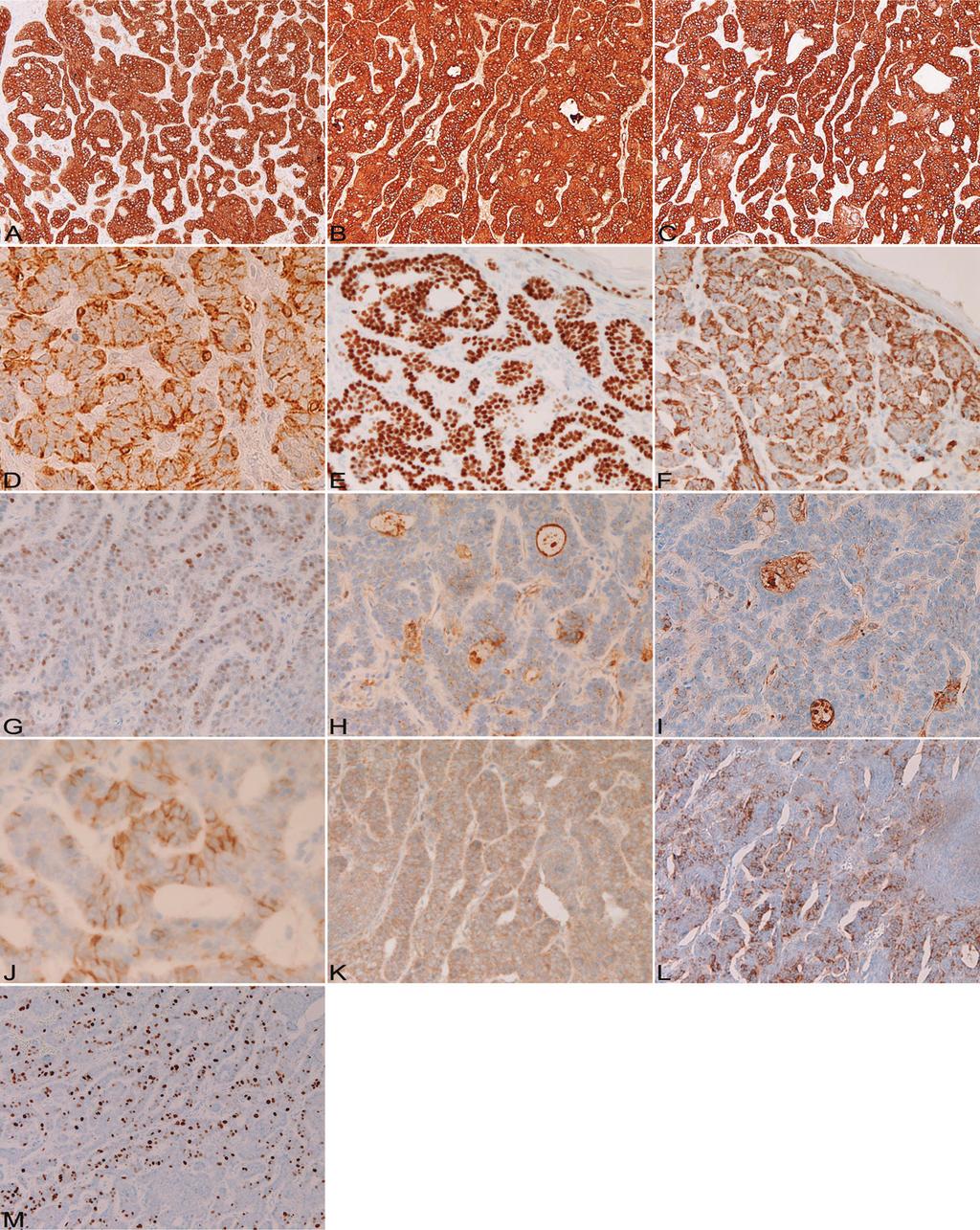 Cutaneous NET Figure 2. Immunohistochemistry. The tumor cells are strongly positive for cytokeratin (CK) 34BE12 (A), CK5/6 (B), CK14 (C), NCAM (CD56) (D), p63 (E), and KIT (CD117) (F).