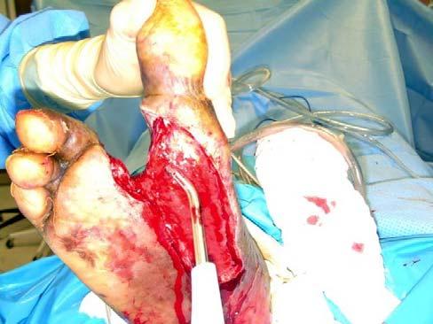 3) During the tension phase, the patient remained in a CAM boot and underwent daily dressing changes. Final closure of the defect was accomplished within just a few days of application. (Fig.
