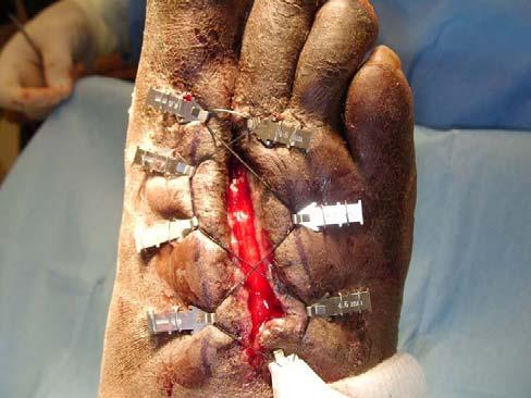 1-1.5 cm from the wound edge. Figure 3 The wound must be surgically debrided of all non-viable tissue prior to application of the device.