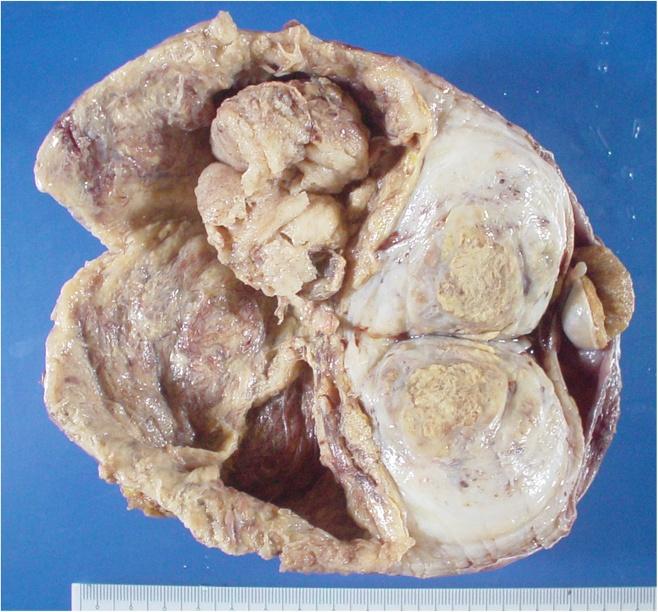Hatanaka et al. Diagnostic Pathology 2013, 8:142 Page 2 of 5 mass, measuring 12 cm in diameter, in the right scrotal sac.