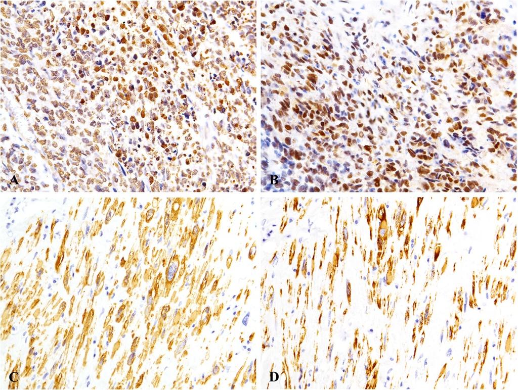 Hatanaka et al. Diagnostic Pathology 2013, 8:142 Page 3 of 5 Figure 3 Immunohistochemical analysis. (A)(B) Sarcomatous component is positive for MDM2 (A) and CDK4 (B).