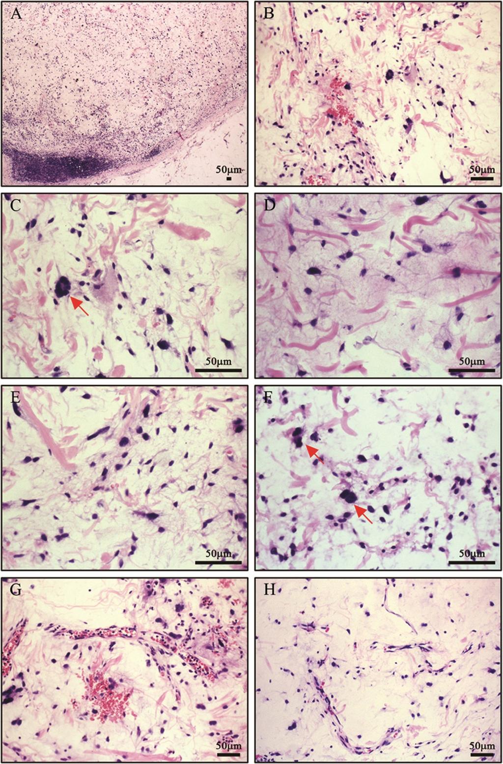 Wang et al. World Journal of Surgical Oncology 2013, 11:145 Page 3 of 5 Figure 1 Histological features. A) The tumor was demarcated from the surrounding tissues with a relatively clear boundary (40 ).