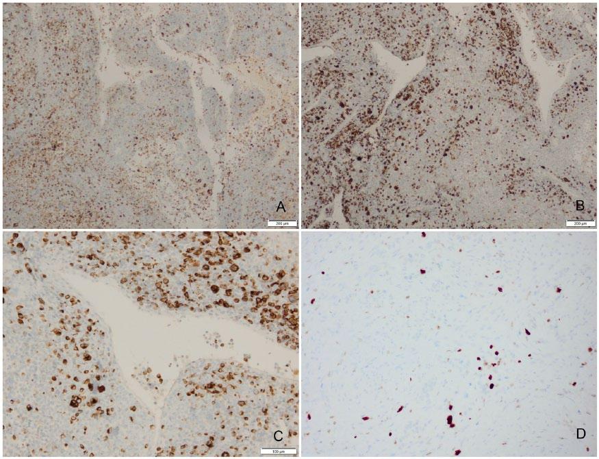 Creytens et al 3 Figure 3. Strong and multifocal expression of the tumor cells for pan-cytokeratin AE1/AE3 (A, original magnification 40 ) and desmin (B and C, original magnification 40 and 100 ).