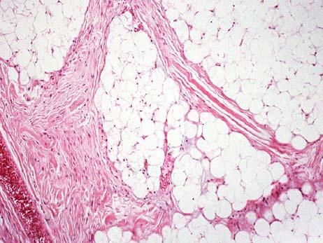 Diagnosis Lipoblastoma Lipoblastoma Benign tumor, typically arises during the first three years of life Slow growing painless mass most often on subcutaneous extremities Lipoblastomatosis: multiple