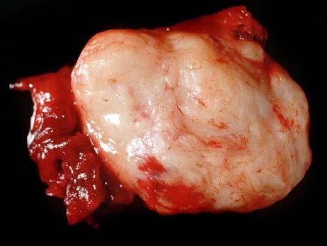 Spindle Cell Lipoma Usually in males 45-70 years Solitary, painless mass on back of neck, shoulders, elsewhere Circumscribed and subcutaneous Spindle Cell Lipoma