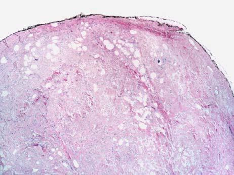 Spindle Cell Lipoma: