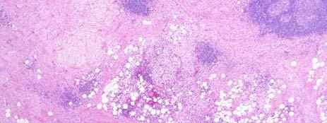 Well-Differentiated Liposarcoma: Sclerosing Type May not appear